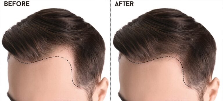 Hair Transplant in Pakistan: A Definitive Guide to Restoring Confidence