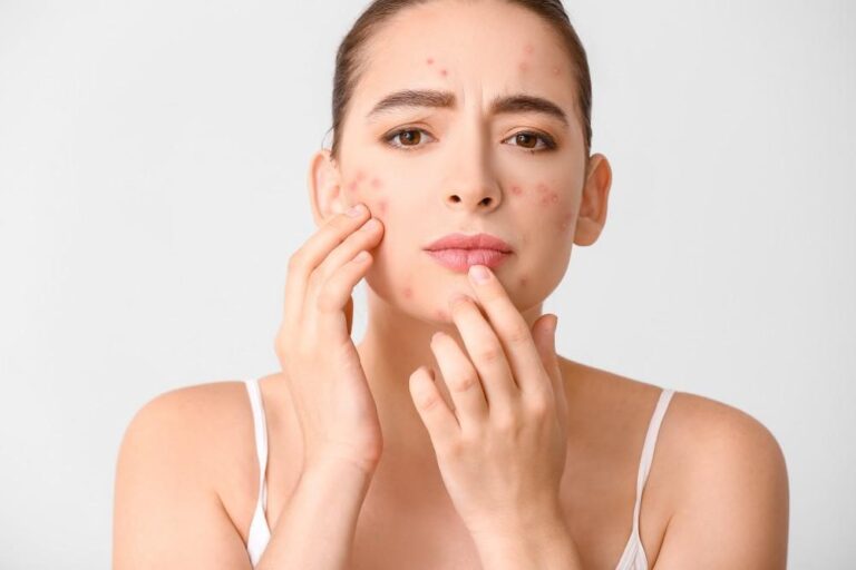 Salicylic Acid and How It Benefits the Skin