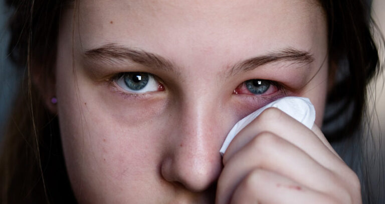 Common Eye Infections and How to Treat Them