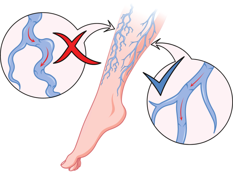 Varicose Veins Treatment