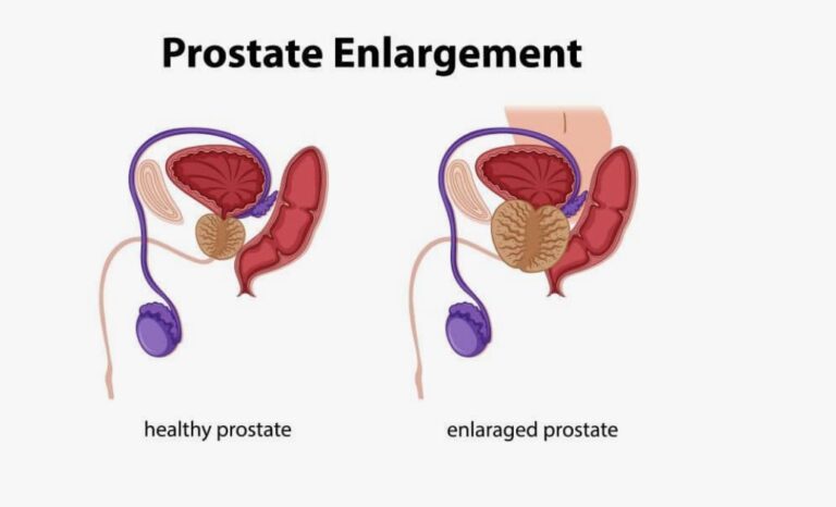 What Men Should Know About Prostate Health