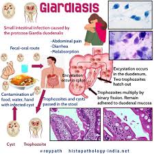 What Are the Complications of Untreated Giardiasis?