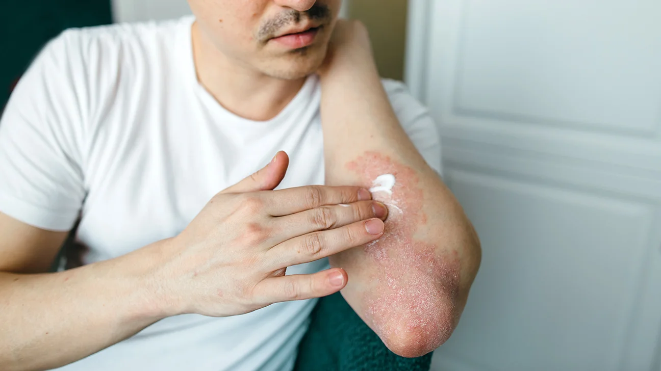 Plaque Psoriasis Drug Pipeline Analysis Report 2024