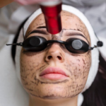 Clear Skin with Freckles Laser Treatment in Guwahati | Quality at Affordable Prices: Essence Skin Clinic