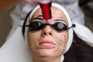 Clear Skin with Freckles Laser Treatment in Guwahati | Quality at Affordable Prices: Essence Skin Clinic