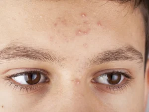 Severe Acne Vulgaris