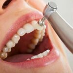 Is deep teeth cleaning in Boise, Idaho, really necessary?