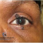 Mole on Lower Eyelid: When to Worry and How to Treat It