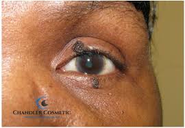 Mole on Lower Eyelid: When to Worry and How to Treat It