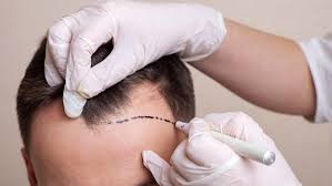 Hair Transplant clinic