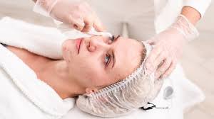 Expert Acne Scars Treatment Doctor in Guwahati: Innovative Acne Scar Removal Techniques | Essence Skin Clinic