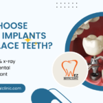 Losing a Tooth? Here’s Why Dental Implants Are Your Ideal Replacement