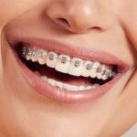 Understanding Braces Types in Nampa, Idaho: Choosing the Right Fit for Your Smile