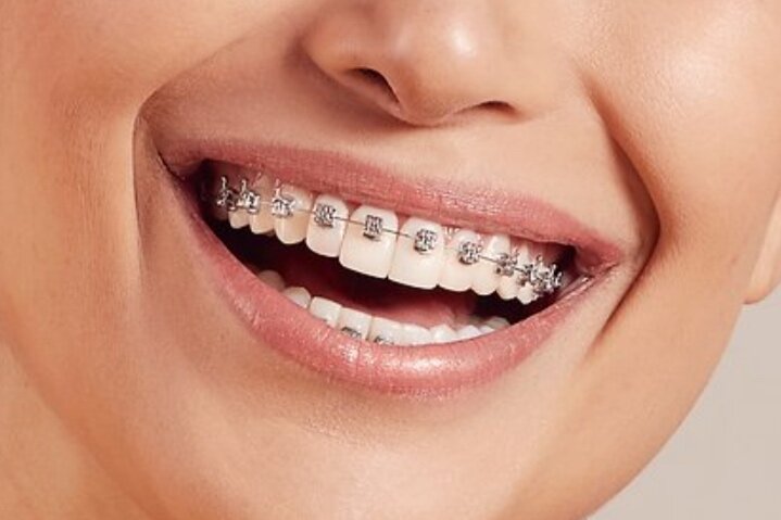 Understanding Braces Types in Nampa, Idaho: Choosing the Right Fit for Your Smile