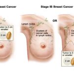 Understanding the Stages of Breast Cancer and Diagnosis