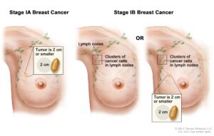 Understanding the Stages of Breast Cancer and Diagnosis