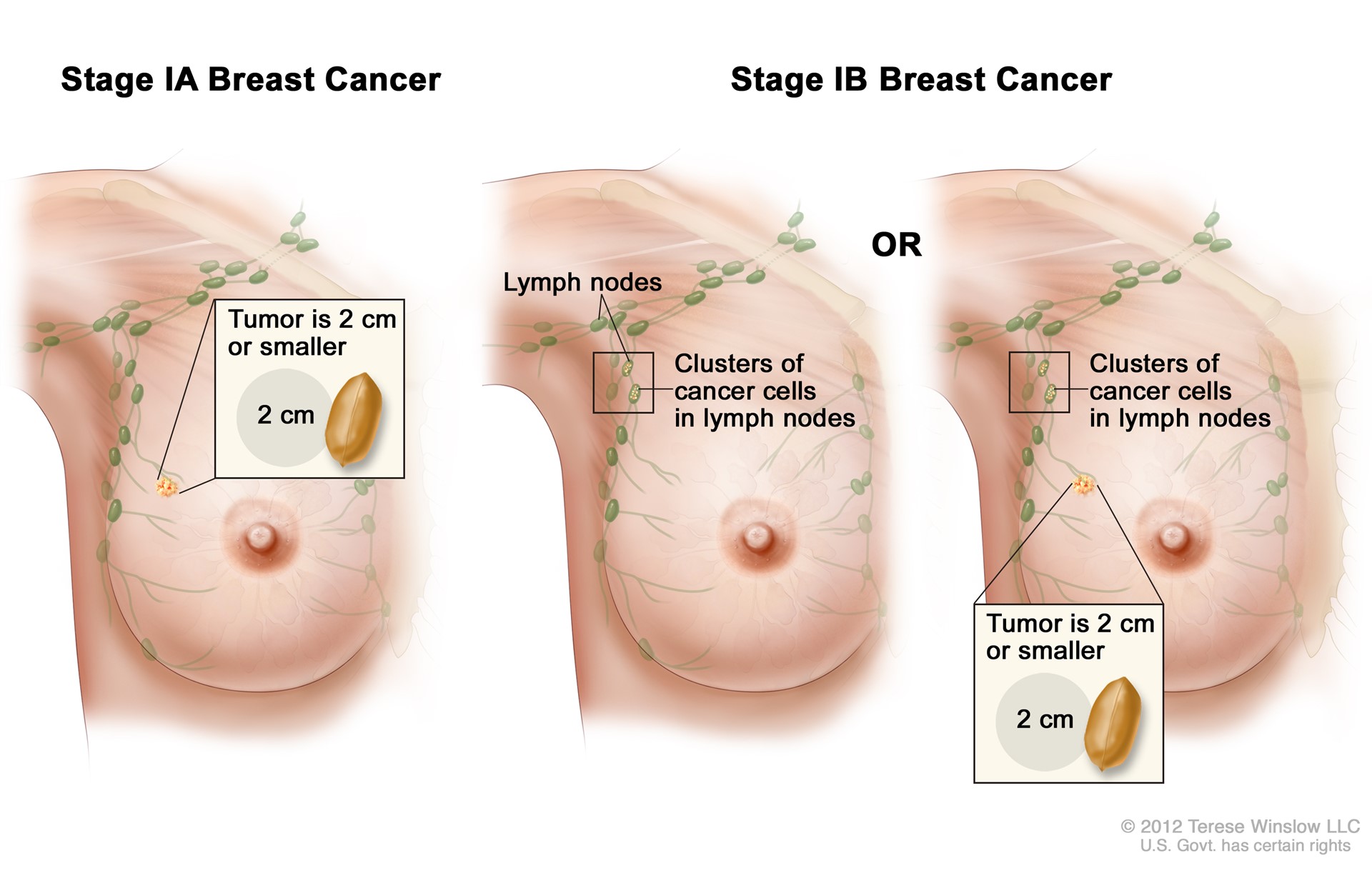 stages of breast cancer