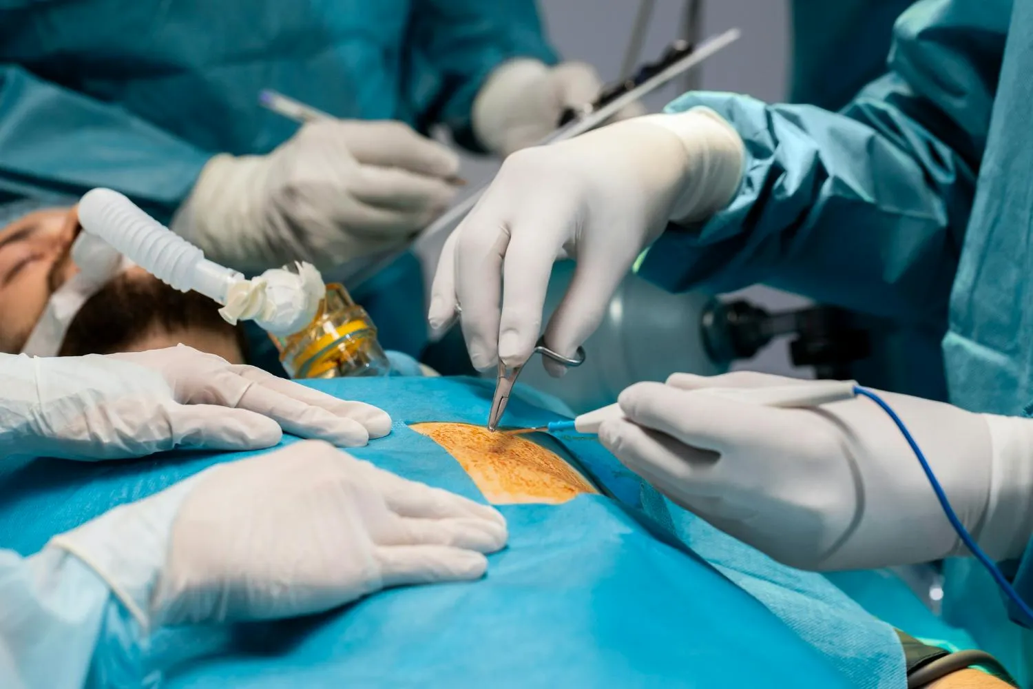 Gallbladder removal surgery in Guwahati