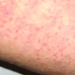 Can Urticaria Be Prevented with Lifestyle Changes?