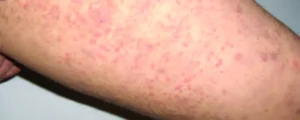 Urticaria