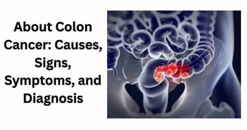colon cancer causes signs symptoms and diagnosis
