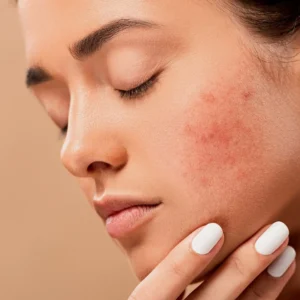 What Is Tretiva and How Does It Treat Acne?