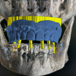 Advanced Implant Planning: The Key To Precision And Predictable Dental Outcomes