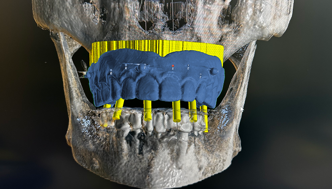 Advanced Implant Planning: The Key To Precision And Predictable Dental Outcomes