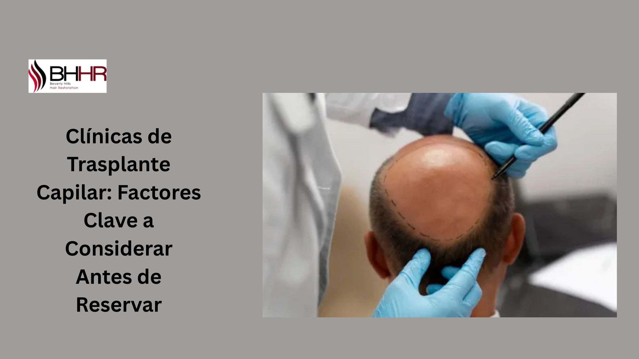 clinicas de implante capilar