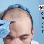 Cost of Hair Transplantation Surgery: Key Factors That Affect Pricing