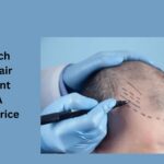 How Much Does a Hair Transplant Cost? A Detailed Price Guide