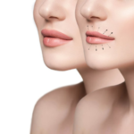 Breast Augmentation Guide and Lip Augmentation Costs