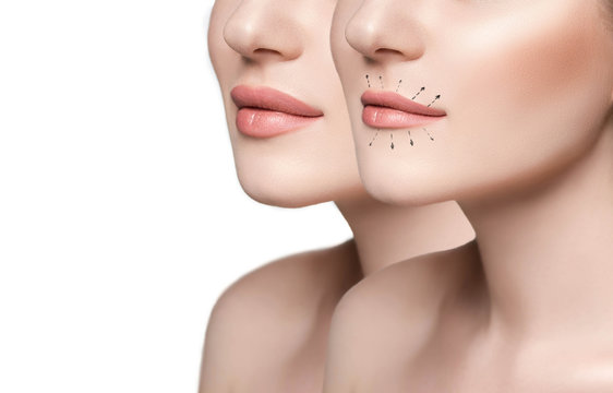 Breast Augmentation Guide and Lip Augmentation Costs
