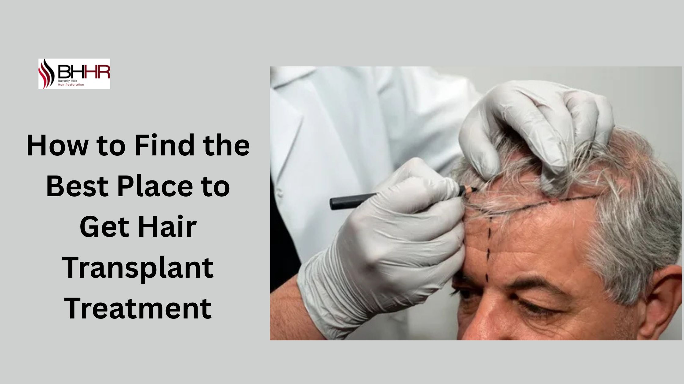 best place to get hair transplant