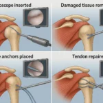 Rotator Cuff Surgery: Everything You Need to Know About Repair, Recovery, and Results