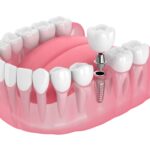 Navigating the Financials: A Guide to West Point Dental Implant Costs