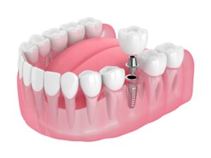 Navigating the Financials: A Guide to West Point Dental Implant Costs