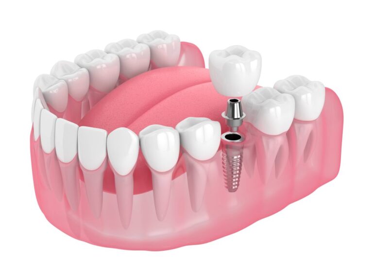 Navigating the Financials: A Guide to West Point Dental Implant Costs