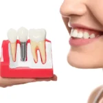 Smiles in a Flash: The Real Advantages of Same Day Implants in Panacea, FL