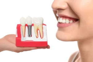 Smiles in a Flash: The Real Advantages of Same Day Implants in Panacea, FL