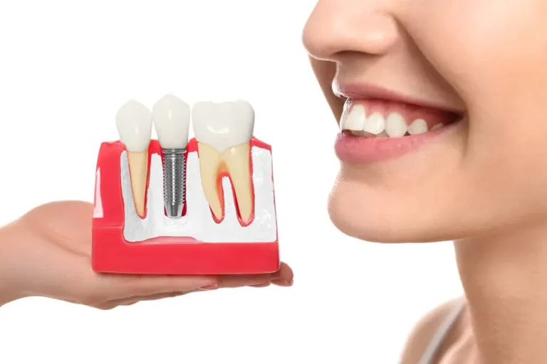 Smiles in a Flash: The Real Advantages of Same Day Implants in Panacea, FL