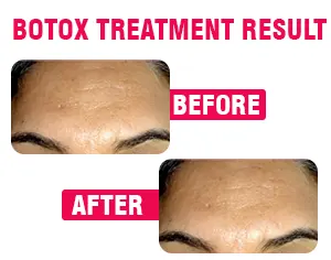 Botox Shots Treatment