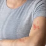 Bacterial vs Fungal Skin Infection: Know the Differences