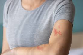 Bacterial vs Fungal Skin Infection: Know the Differences