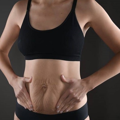 Tummy Tuck Healing Tips for Faster Recovery