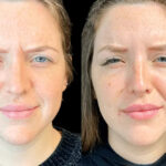 How the Best Doctors in Dubai Help Prevent Premature Aging with Botox
