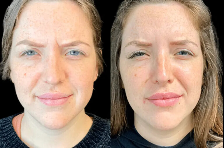 How the Best Doctors in Dubai Help Prevent Premature Aging with Botox