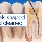 Root Canals: Understanding the Procedure, Benefits, and Recovery Process