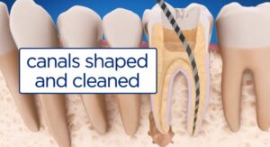 Root Canals: Understanding the Procedure, Benefits, and Recovery Process