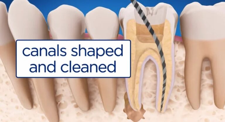 Root Canals: Understanding the Procedure, Benefits, and Recovery Process